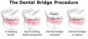 Dental-bridges